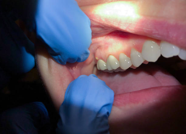 Best Emergency Treatment for Dental Infections or Abscesses in Edgewood, TX
